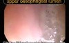Tracheoesophageal fistula and the upper oesophageal lumen upon voice prosthesis removal