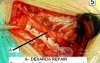 Inguinal hernia repair without mesh