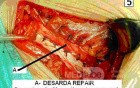 Inguinal hernia repair without mesh