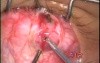 Atraumatic inferior oblique myomectomy