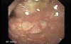 Rectum (12 of 30)