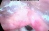 Hoarse Voice caused by Laryngeal Web 