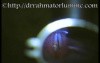 Cordectomy and Subtotal Arytenoidectomy (Laser)