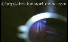 Cordectomy and Subtotal Arytenoidectomy (Laser)