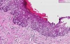 Proliferative endometrium