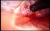 Colonic Perforation With Peritonitis - Laparoscopy (44 of 46)