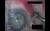 Cataract Surgery - Part 3