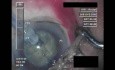 Cataract Surgery - Part 3