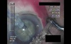 Cataract Surgery - Part 3