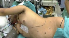 Laparoscopic splenectomy
