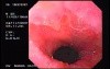 Barrett´s Esophagus (1 of 2)