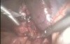 Laparoscopic exploration of Common Bile Duct (CBD)