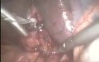 Laparoscopic exploration of Common Bile Duct (CBD)