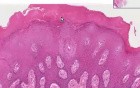 Reactive hyperkeratosis - Histopathology of Mouth