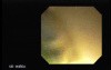 Choledocoduodenostomy and The Sump Syndrome (7 of 10)