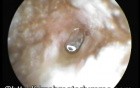 Active Stage of Chronic Suppurative Otitis Media-Pulsating Air Bubble 