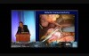 Extended Colonic Resection Lapaparoscopic vs Robotic