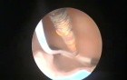 Contraception Complication - Missed Parts of Intrauterine Device Management