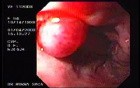 Banding of Esophageal Varices - Closer Look at the Ligated Varix