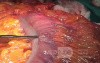 Endoscopic Image of Adenocarcinoma of the Transverse Colon (5 of 9)