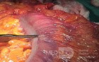 Endoscopic Image of Adenocarcinoma of the Transverse Colon (5 of 9)