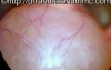 Massive Vallecula Cyst