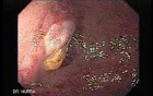 Gastrointestinal Stromal Tumour of the Rectum (2 of 3)