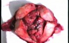 Total Hysterectomy Performed for Endometrial Cancer