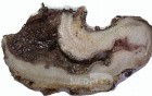 Plastic Linitis with bilateral Krukenberg´s tumor (10 of 13)