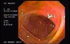 A Tablet of Medicine in the Colon (2 of 2)