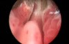 Greenlight HPS Prostatectomy - Part 1