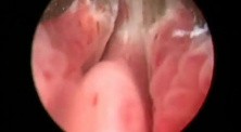 Greenlight HPS Prostatectomy - Part 1