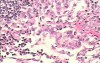 Adenocarcinoma of the cardias and gastric fundus with signet-ring cells (21 of 25)