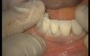 Upper Arch Teeth Preparation And Provisional Crowns (5/5)