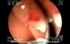 Giant Duodenal Papilla Tumor