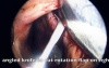 Nasal Septal Perforation Repair