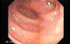 Adenocarcinoma of the Transverse Colon (2 of 5)
