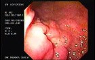 Irregular Ulcer at the Corpus - 92 Years-Old Male
