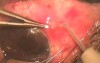 Glaucoma Surgery - Failed Surgery With Drainage Of Both Eye Chamber
