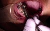 The Trick To Removing Composite From Enamel