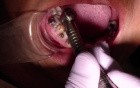 The Trick To Removing Composite From Enamel