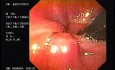 Flexible Endoscopic Suturing - Withdrawal of the Clamp
