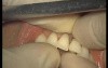 Glass Ionomer Cementation (5/6)