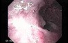 Long Standing Alcohol Abuse - Follow Up After Ligation Treatment