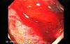Duodenal Ulcer and Bleeding (1 of 23)