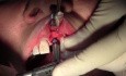 Osteotomy Prep & Implant Insertion - Implant Placement #9