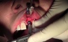 Osteotomy Prep & Implant Insertion - Implant Placement #9