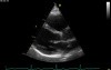 Real-Time Three Dimensional Echocardiography - Parasternal Long Axis View on Mitral Valve, Video nr 2