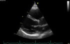 Real-Time Three Dimensional Echocardiography - Parasternal Long Axis View on Mitral Valve, Video nr 2