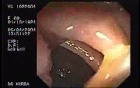Sessile Villous Adenoma (1 of 3)